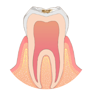 C1：エナメル質のむし歯