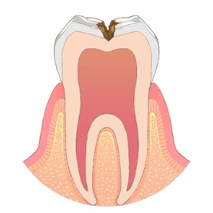 C2：象牙質のむし歯