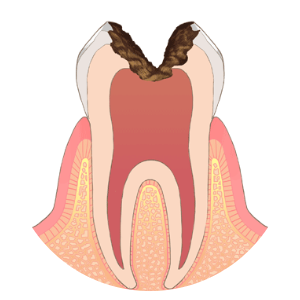 C3：神経まで達したむし歯