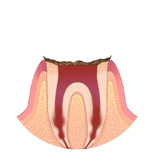 C4：歯の根まで達したむし歯
