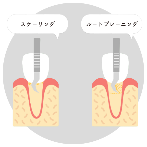 ● スケーリング・ルートプレーニング