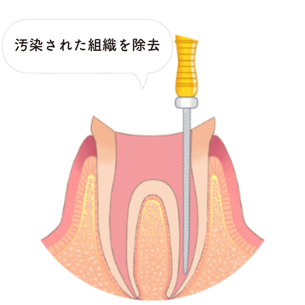 STEP1：感染した歯髄の除去