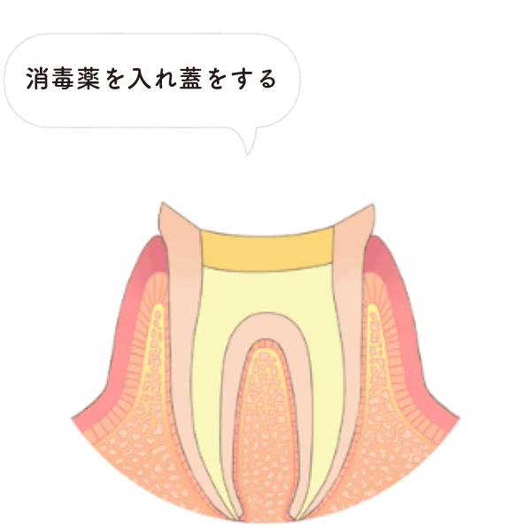 STEP2：根管内の洗浄と消毒