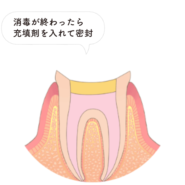 STEP3：根管の充填と封鎖